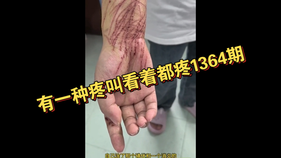有一种疼叫看着都疼136...