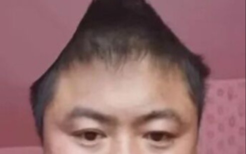 丽丽脑壳切除手术全过程流...